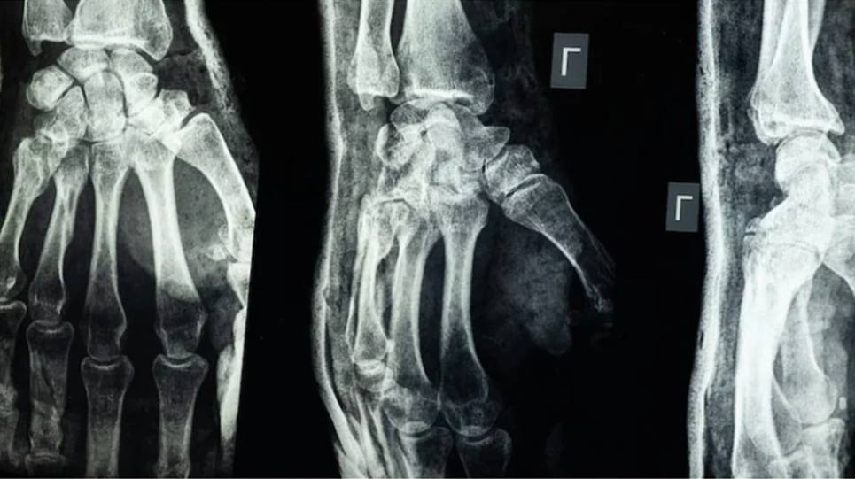 অর্থোপেডিক চিকিৎসায় নতুন দিগন্ত: ভাঙা হাড় জোড়া লাগবে মাত্র ৩ মিনিটে